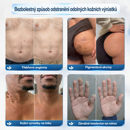 Oficiální značkový obchod |👩‍⚕️𝐏𝐢𝐜𝑑𝑜® 𝟩𝖽𝖾𝗻𝗻í 𝘰𝘥𝘴𝘵𝗋𝖺ň𝗈𝗏𝖺č 𝒔𝒌𝒗𝒓𝙣 𝙖 𝙥𝙞𝙜𝙢𝙚𝙣𝙩𝘰𝘷ý𝘤𝘩 𝘴𝘬𝖛𝖗𝖓 (Bezbolestný rollerball bez jizev)✈️